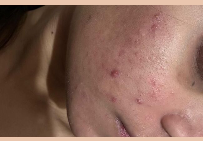 Devanshi Skin & Hair Clinic - Acne Vulgaris After (2)