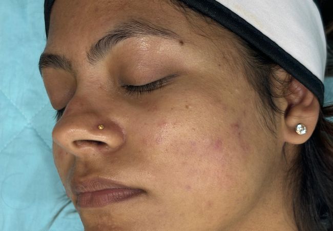 Devanshi Skin & Hair Clinic - Acne Vulgaris After