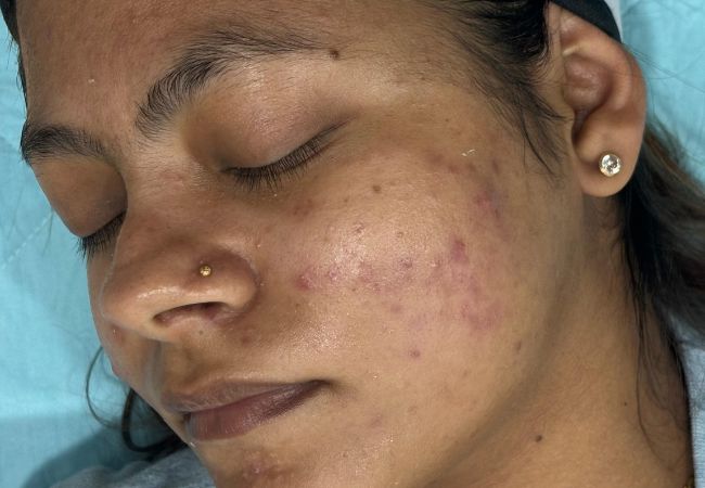 Devanshi Skin & Hair Clinic - Acne Vulgaris Before