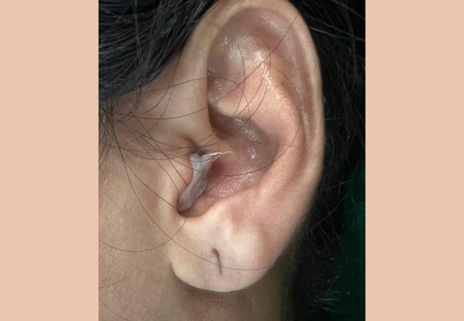 Devanshi Skin & Hair Clinic - Ear Lobe repair Before