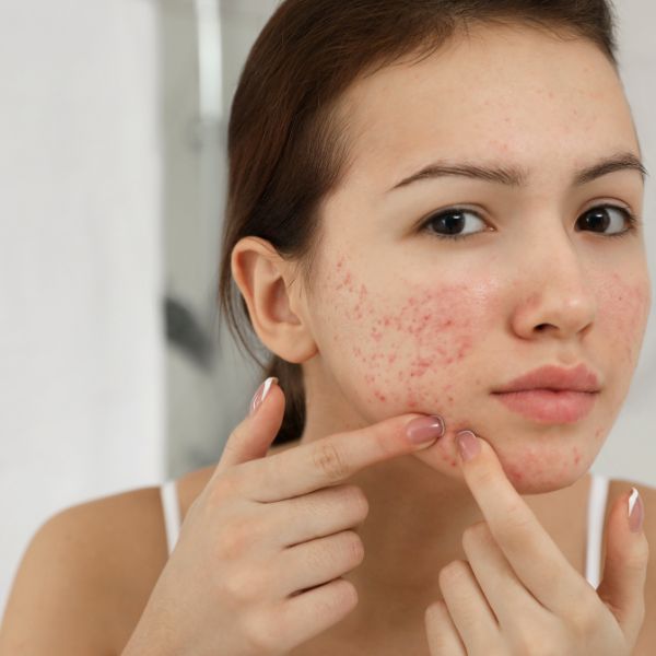 Devanshi Skin & Hair Clinic - Skin Treatment - Acne Treatment