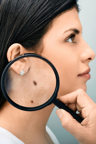 Devanshi Skin & Hair Clinic - Skin Treatment -Moles Treatment