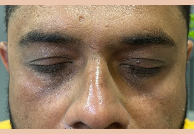 Devanshi Skin & Hair Clinic - Under eye treatment_ Chemical peel Before