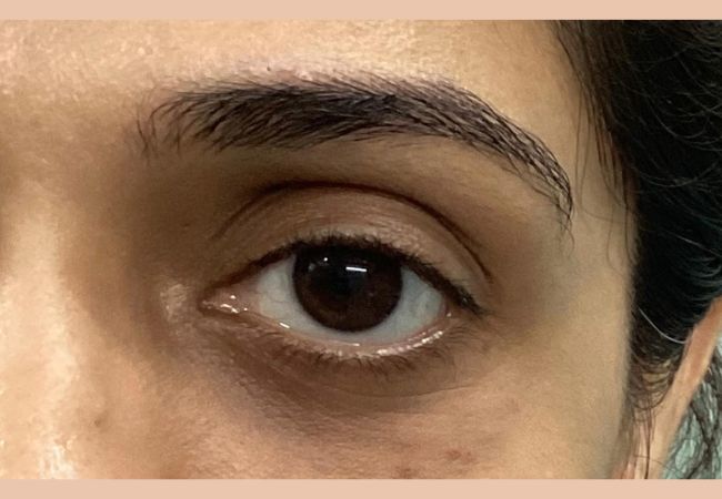 Devanshi Skin & Hair Clinic - Undereye filler After