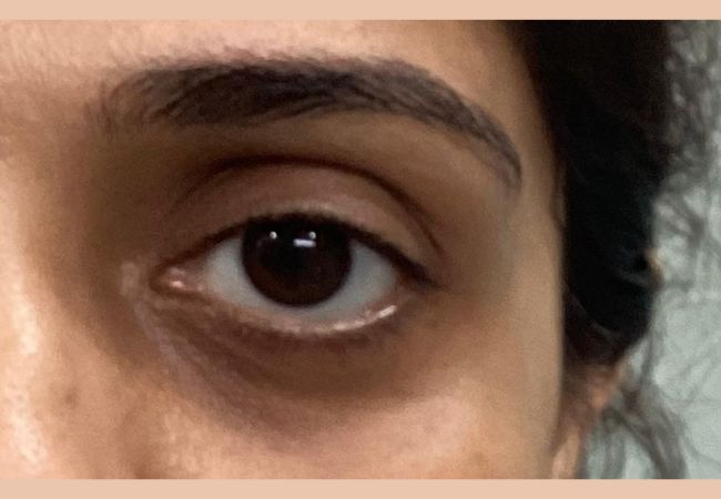 Devanshi Skin & Hair Clinic - Undereye filler Before