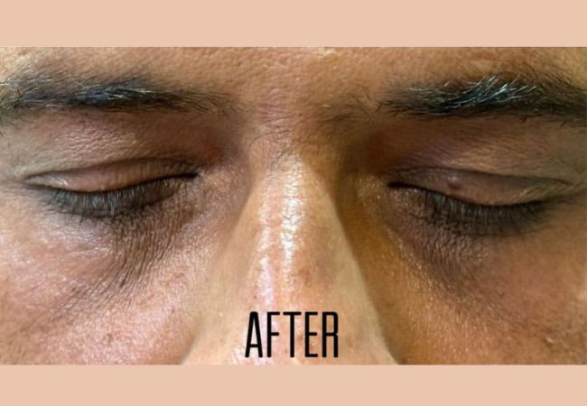 Devanshi Skin & Hair Clinic - Undereye – after chemical peel