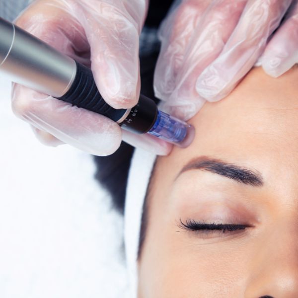 Devanshi Skin & Hair Clinic Cosmetic Treatments - Milifrac - Advanced Microneedling Therapy