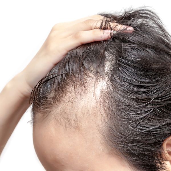 Devanshi Skin & Hair Clinic Hair Treatments - Alopecia